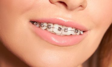 Fogszabalyozas-felnottkorban-–-sosincs-keso-belevagni_kep2 Fogszabalyozas-felnottkorban-–-sosincs-keso-belevagni_kep2