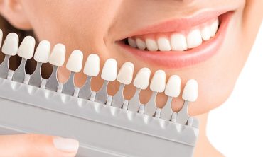 fogfeherites Beautiful smile and white teeth of a young woman. Matching the shades of the implants or the process of teeth whitening.