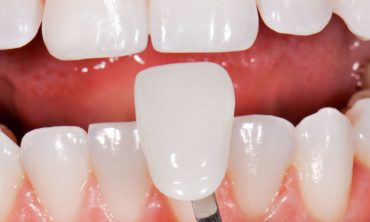 porcelan-keramia-fogaszati-hejak-01-1024×585 porcelan-keramia-fogaszati-hejak-01-1024x585